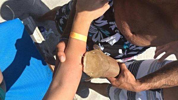 tiburon-prendido-brazo-mujer_CLAIMA20160516_0161_28