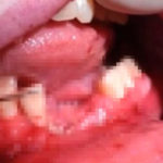 Pierde sus dientes al fumar