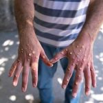 Temen brote de viruela del mono