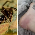 Una mujer fue picada por una araña, su vida corrió riesgo y al final perdió una pierna